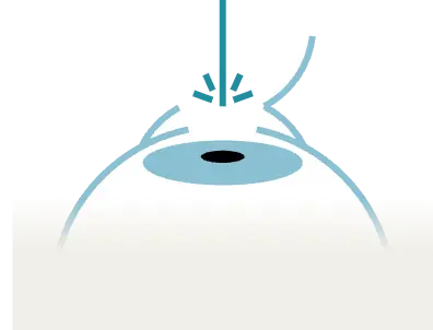 Schéma explicatif de la chirurgie réfractive avec la méthode LASIK - Innovation technologique en ophtalmologie dans l'Oise