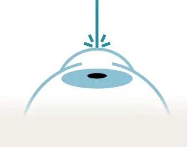 Schéma explicatif de la chirurgie réfractive avec la méthode PKR Photorefractive Keratectomy - Innovation technologique en ophtalmologie dans l'Oise